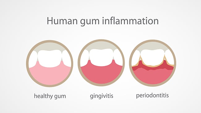 Gingivitis (Gum Inflammation) - Causes, Symptoms and Treatment